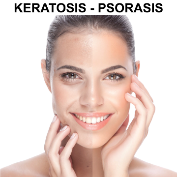 Glycolic Peel System for Keratosis, Psorasis, Ezcema