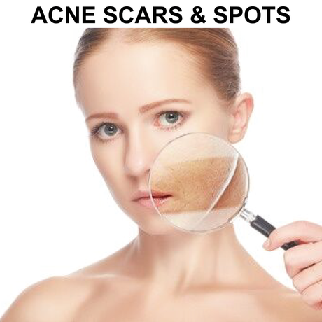 Glycolic Peel System for Acne Scarred Skin & Skin Discoloration