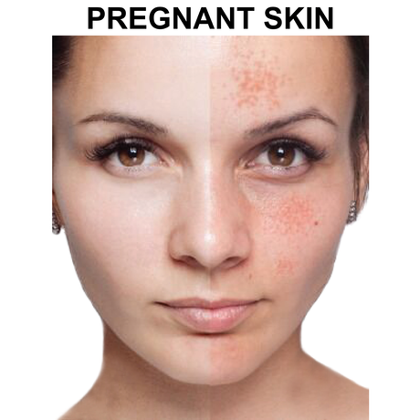 Glycolic Peel System for Pregnancy Skin